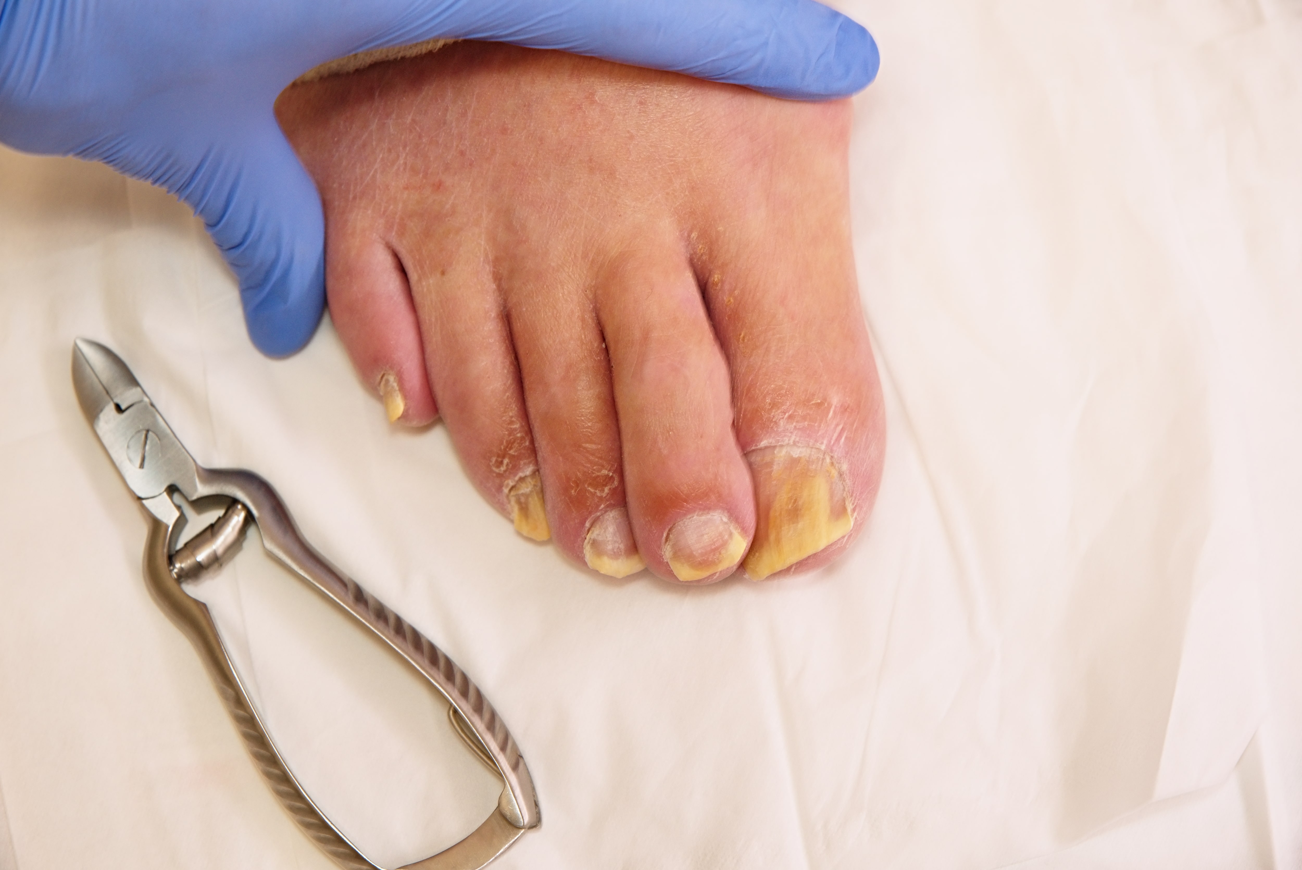 A photograph of an ingrown toe nail